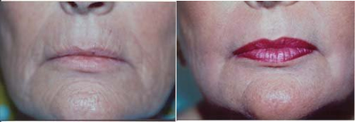 Laser Resurfacing before and after photo