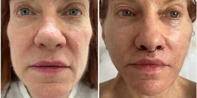 Lip Lift before and after photo