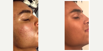 Microneedling before and after photo
