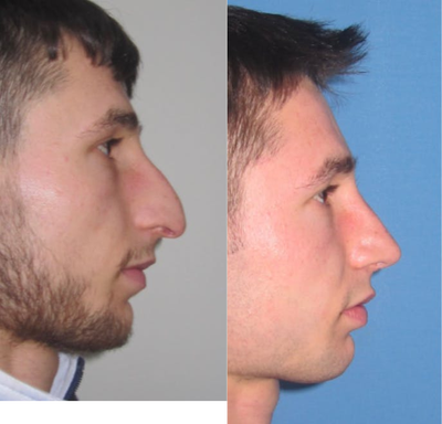 Rhinoplasty before and after photo