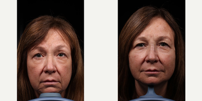 Thread Lift before and after photo