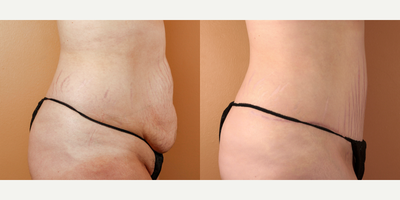 Tummy Tuck before and after photo