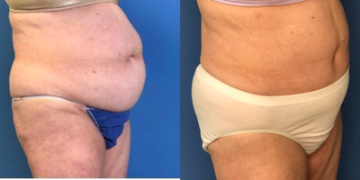 Tummy Tuck before and after photo