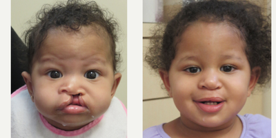 Cleft Lip And Palate Repair before and after photo