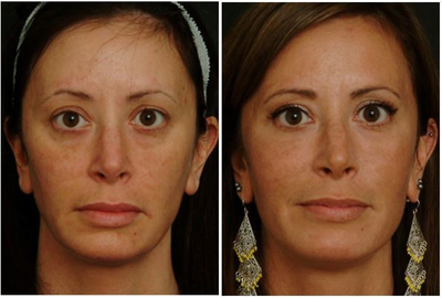 Facial Fat Transfer before and after photo