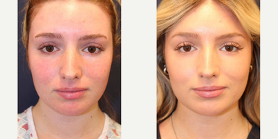 Liposuction before and after photo