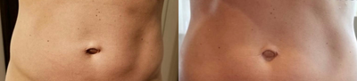 Emsculpt before and after photo