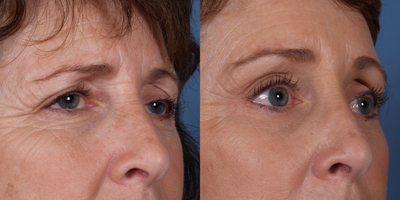 Eyelid Surgery before and after photo
