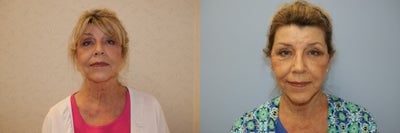Facelift before and after photo