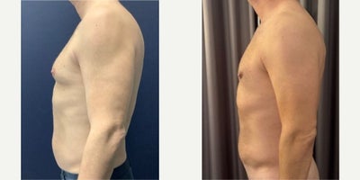 Liposuction before and after photo