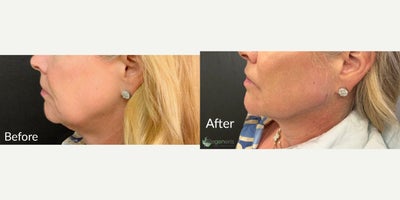 Cheek Fillers before and after photo