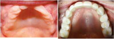 Dental Implants before and after photo