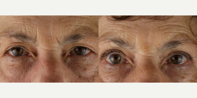 Eyelid Surgery before and after photo