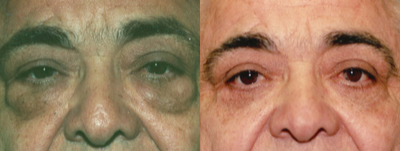 Eyelid Surgery before and after photo