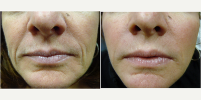 Radiesse before and after photo