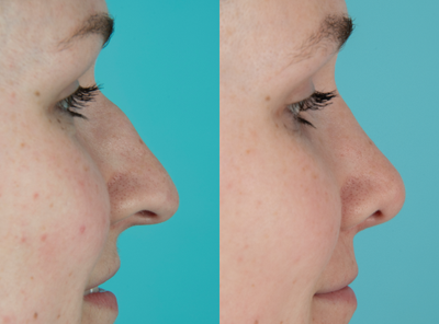 Rhinoplasty before and after photo