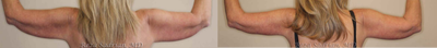 Arm Lift before and after photo