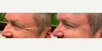 Botox before and after photo