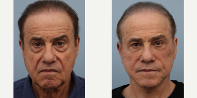 Deep Plane Facelift before and after photo