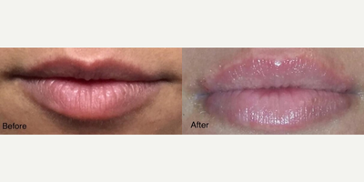 Dermal Fillers before and after photo