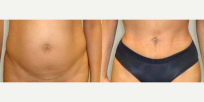 Liposuction before and after photo