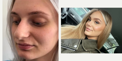 Revision Rhinoplasty before and after photo