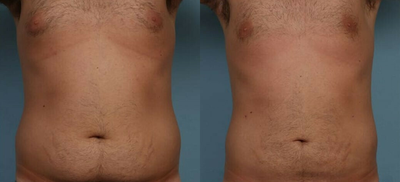 CoolSculpting before and after photo