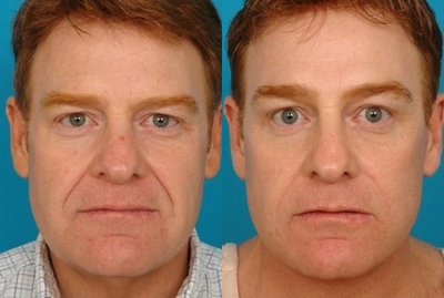 Brow Lift before and after photo