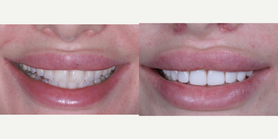Porcelain Veneers before and after photo