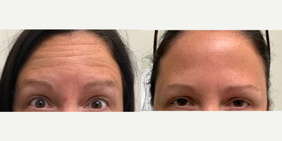 Dysport before and after photo