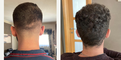 Hair Loss Treatment before and after photo