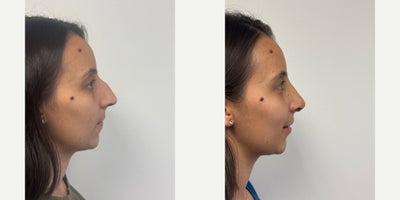 Rhinoplasty before and after photo