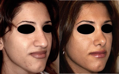 Rhinoplasty before and after photo