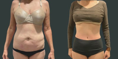 Tummy Tuck before and after photo