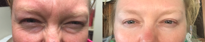Botox before and after photo