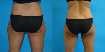 CoolSculpting before and after photo