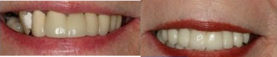Dental Crown before and after photo