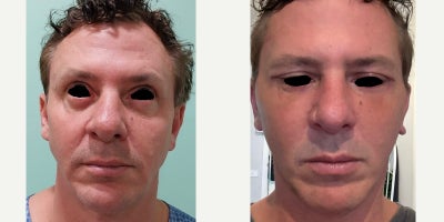 Eyelid Surgery before and after photo