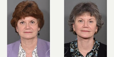Facelift before and after photo