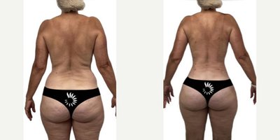 Laser Liposuction before and after photo