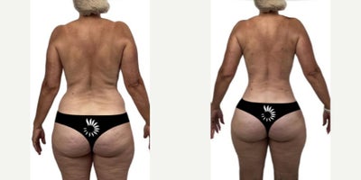 Laser Liposuction before and after photo