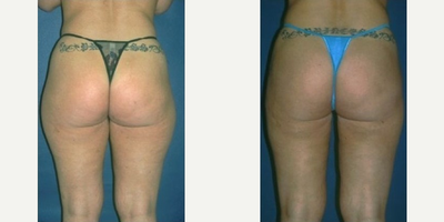 Liposuction before and after photo