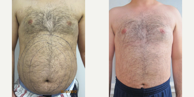 Liposuction before and after photo