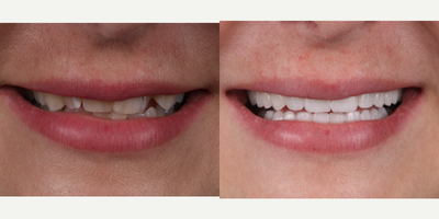 Porcelain Veneers before and after photo