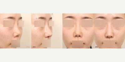 Asian Rhinoplasty before and after photo