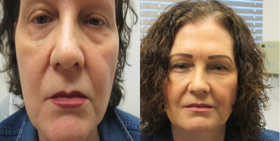 Botox before and after photo
