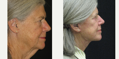 Neck Lift before and after photo