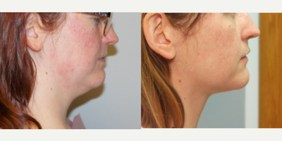 Neck Lift before and after photo