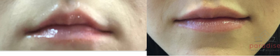 Volbella before and after photo