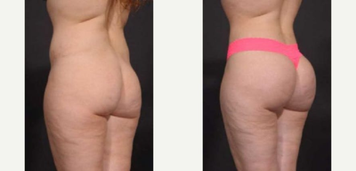 Brazilian Butt Lift before and after photo